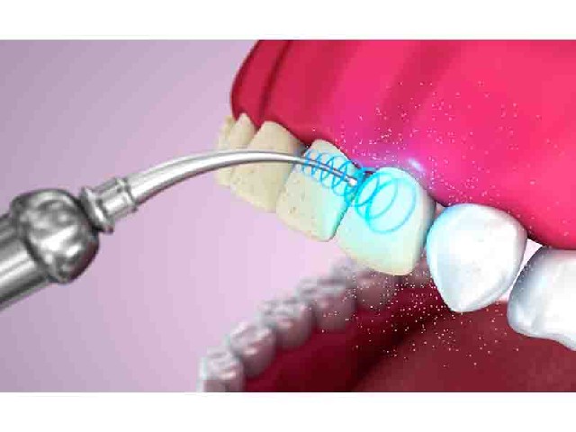Снятие зубных отложений с помощью ультразвука Стоматологическая клиника Дента Стар г Курган